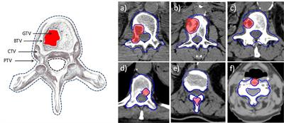 Personalized Automation of Treatment Planning for Linac-Based Stereotactic Body Radiotherapy of Spine Cancer